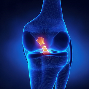 ACL Reconstruction